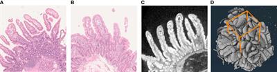 Validation of the X-ray microtomography in the assessment of duodenal morphometry and surface area in celiac disease